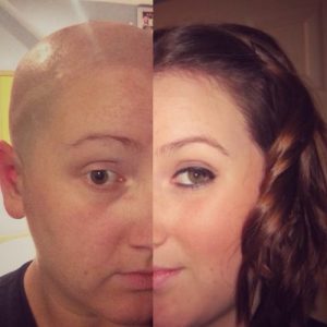 Living with Alopecia: How To Accept Yourself - Differences And All