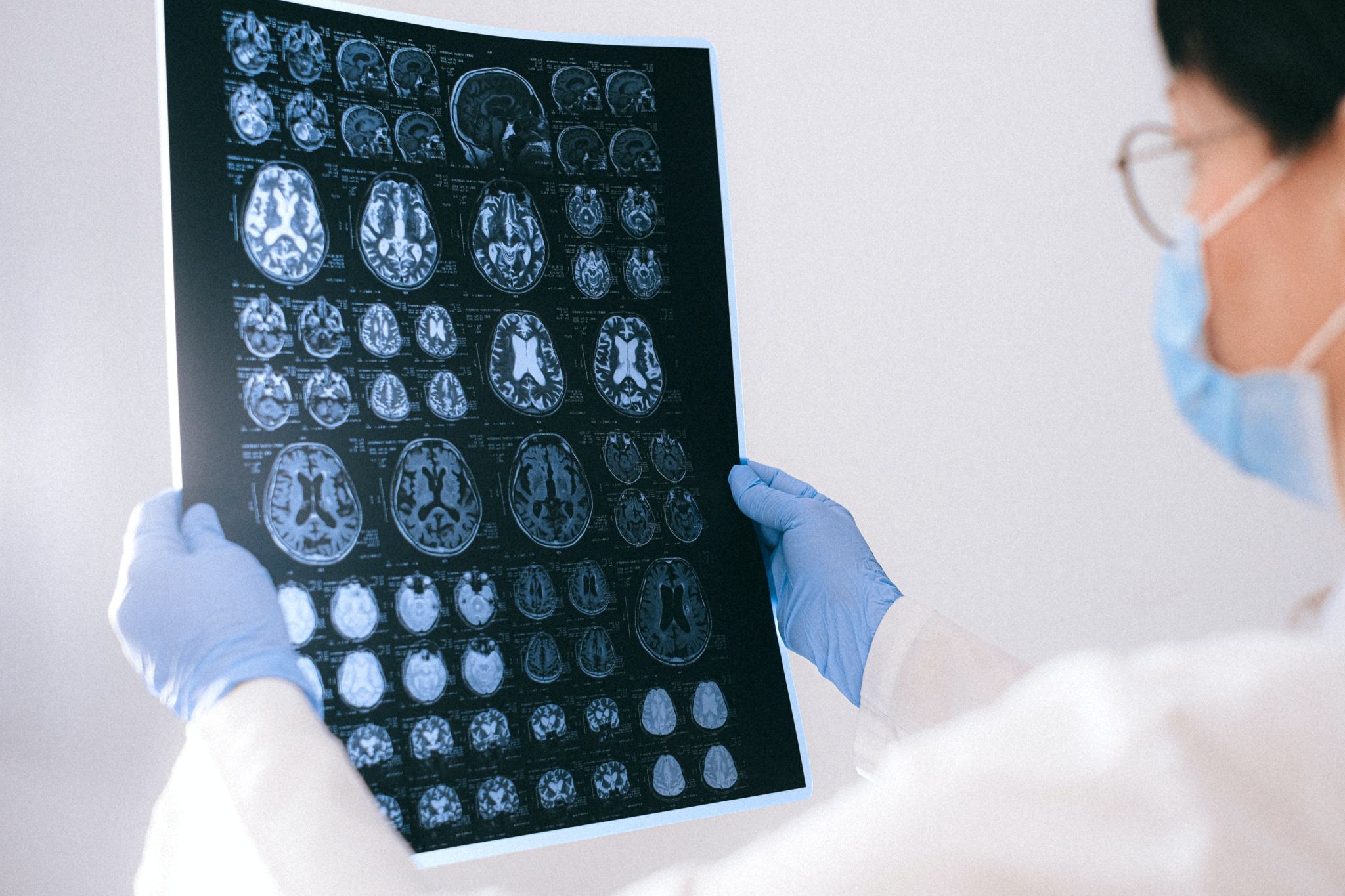 TBI Settlement: How Much Is A Traumatic Brain Injury Case Worth