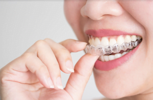 What You Need To Know Before Getting Braces