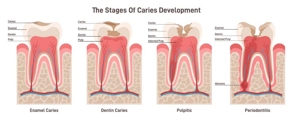 Tooth nerve pain – causes, treatments with and without nerve removal