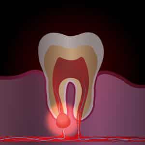 Tooth nerve pain – causes, treatments with and without nerve removal