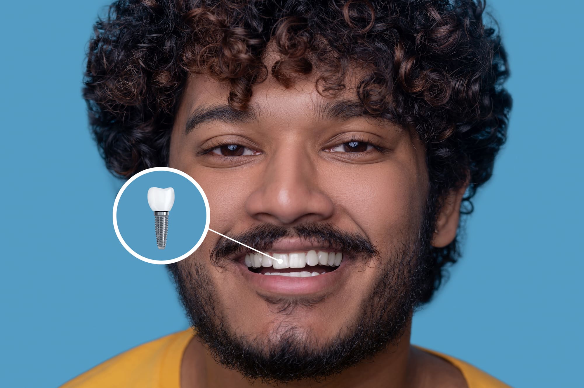 Why Dental Implants Are the Best Choice for Long-Term Oral Health