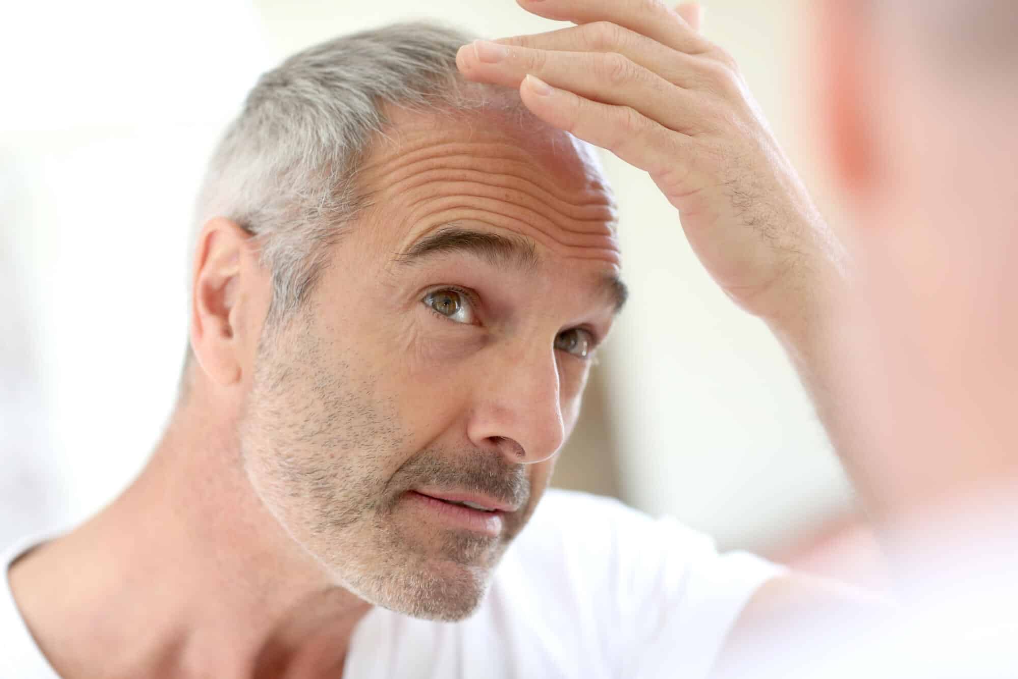 How Do Surgeons Determine the Donor Area for a Hair Transplant?