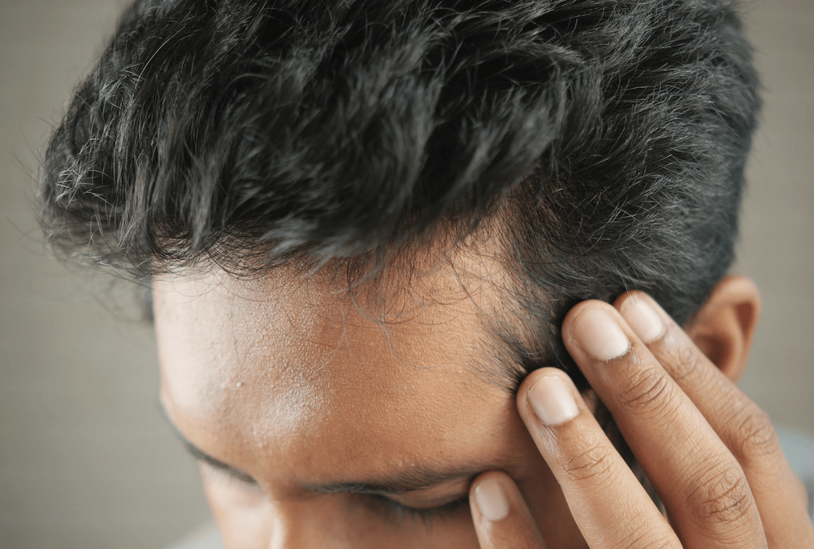 Essential Factors to Consider Before Getting a Hair Transplant