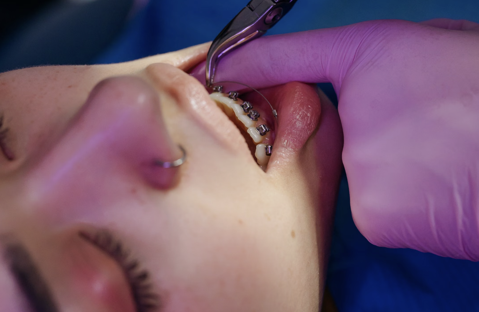 What to Know Before You Start Orthodontic Treatment