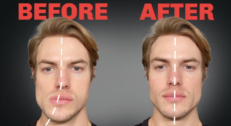 Restoring Facial Symmetry and Bone Support: The Science of Non-Surgical Sculpting 
